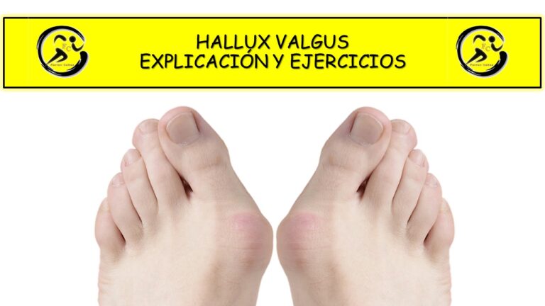 HALLUX VALGUS